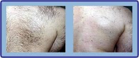 Laser Hair Removal Group 378544 Image 4